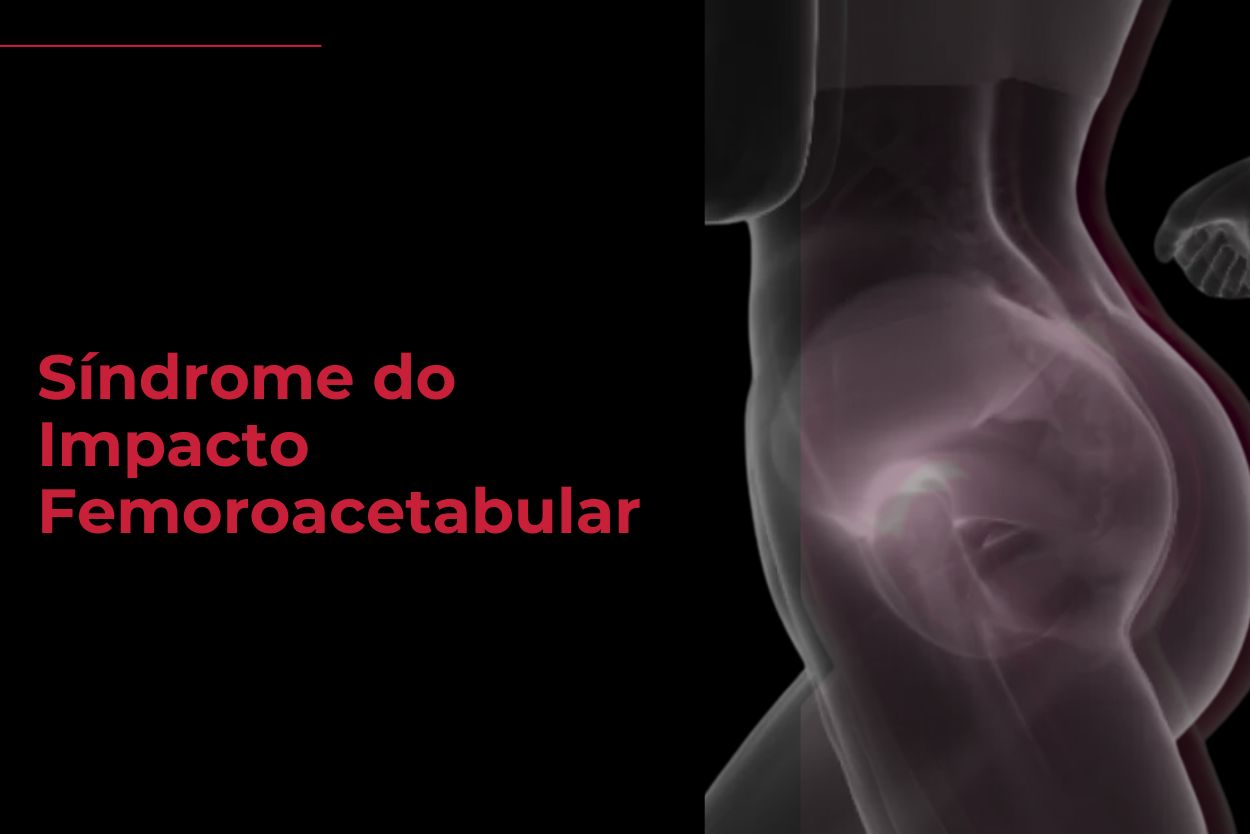 Tratamento Síndrome do Impacto Femoroacetabular Florianopolis