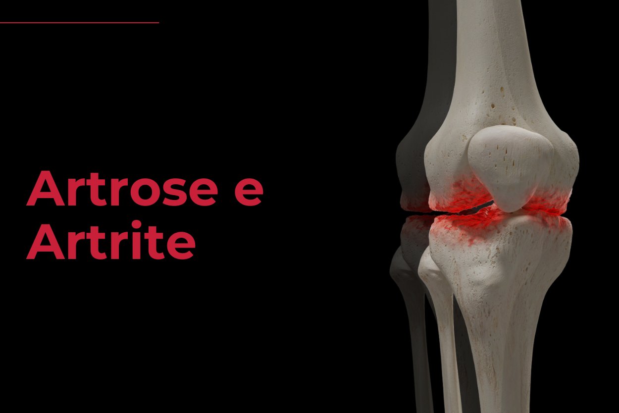 Artrose e Artrite - Reab Fisioterapia Florianopolis