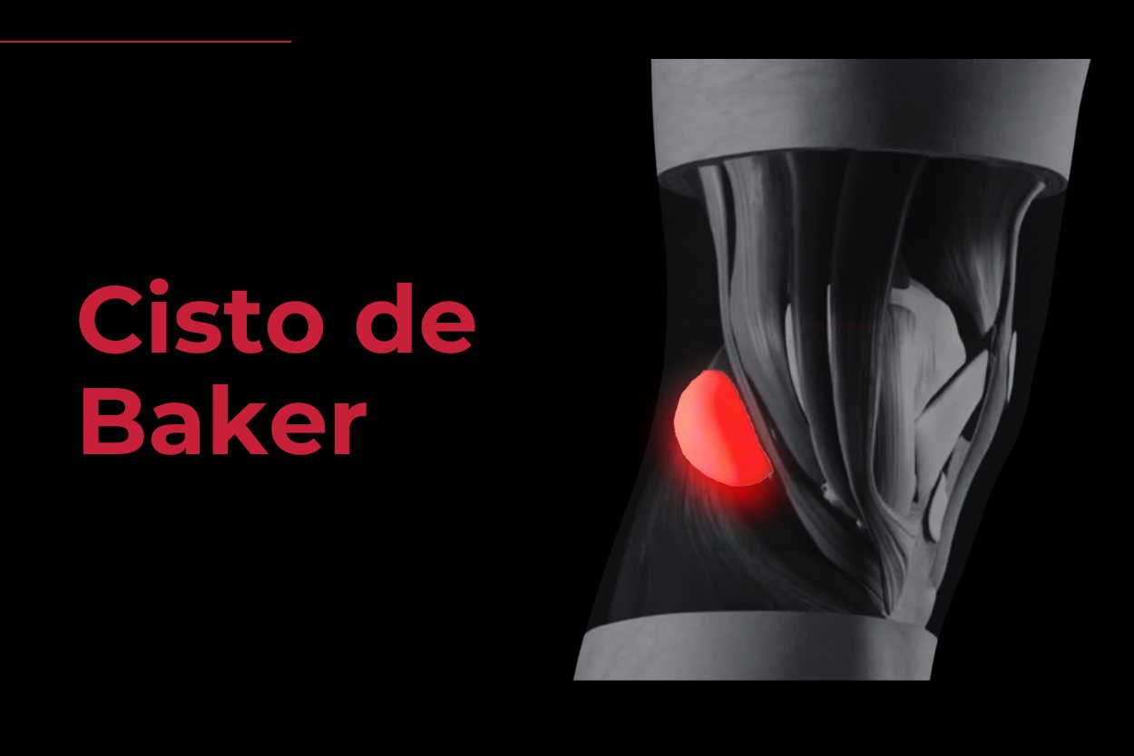 Cisto de Baker - Fisioterapia Reab Florianopolis