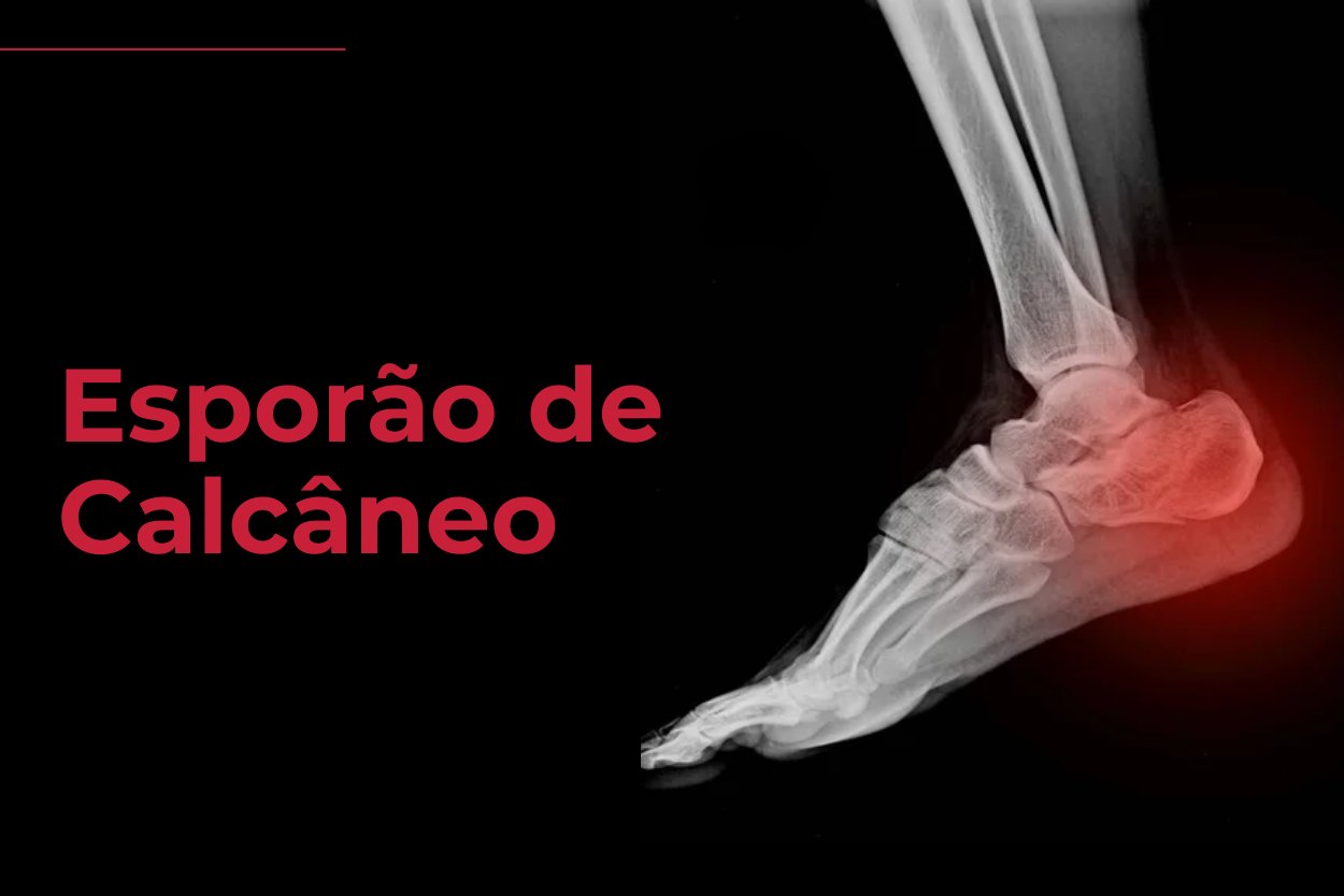 Esporao de Calcaneo REab Fisioterapia Florianopolis