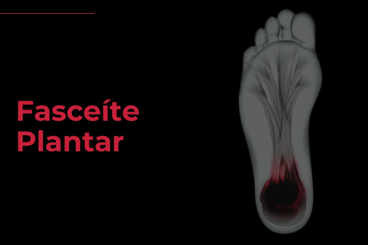 Fasceite Plantar - Reab Florianopolis