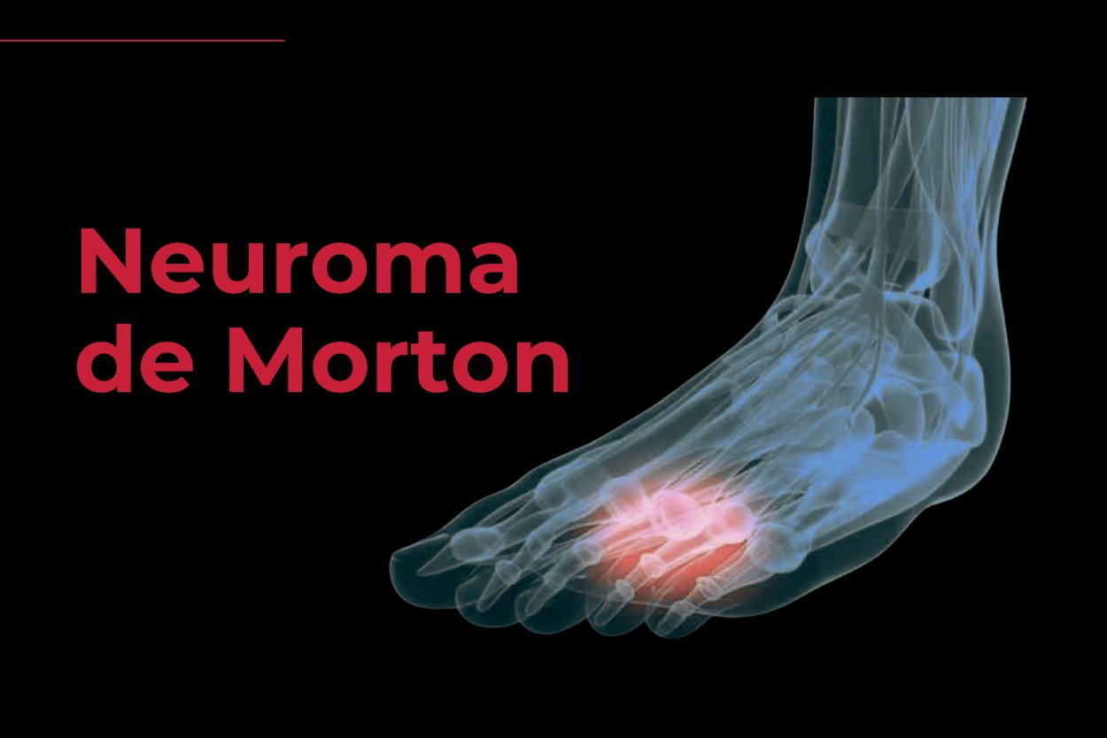 Neuroma de Morton - Florianopols - Reab