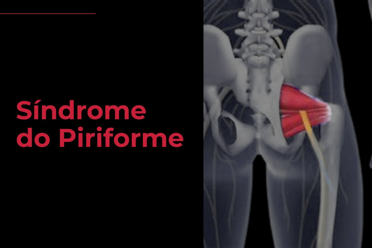 Sindrome do Piriforme - Fisioterapia Florianopolis